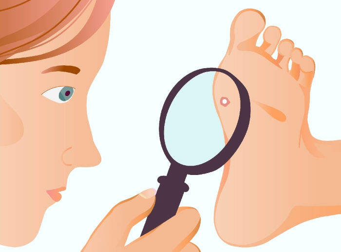 Henkilö tarkastelee suurennuslasilla toisen jalkapohjaa syylän hoidon näkökulmasta.