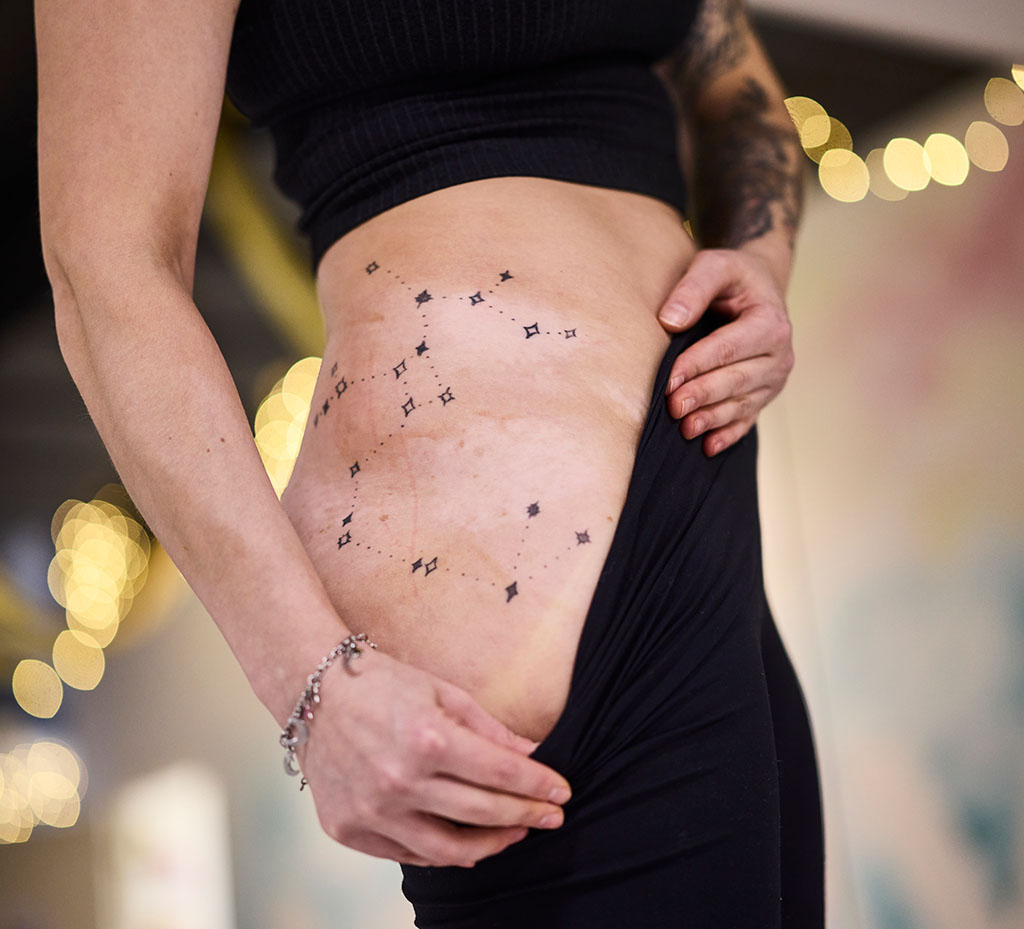 Vitiligo lantiolla Sofia Hako